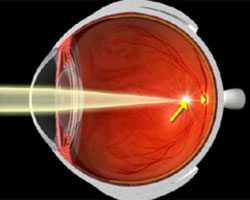 Cross-section of a myopic eye focusing light in front of the retina