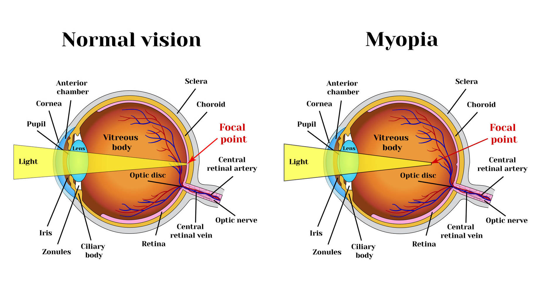 Vision training exercises for myopia (nearsightedness)