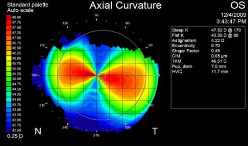 乱視の角膜の軸方向曲率を示すトポグラフィーマップ
